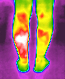 静脉曲张 静脉曲张